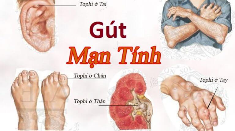 Cách Phòng Ngừa Và Kiểm Soát Gout Mạn Tính